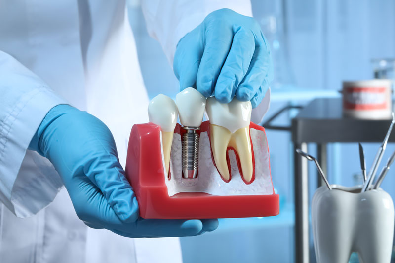 A person in blue gloves holding a dental implant model next to natural teeth, demonstrating how dental implants work. The setting appears to be a dental clinic.